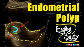 Endometrial Polyp || Ultrasound || Case 250