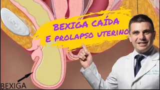 Bexiga Caída e Prolapso Uterino