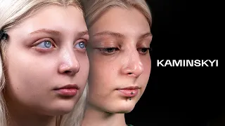 Predictability rhinoplasty. Important stages for the successful result / KAMINSKYI