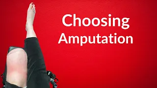 Amputee by Choice: How to Choose Amputation