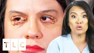 Dr. Lee Removes Numerous Cysts From Woman's Eyelids | Dr. Pimple Popper