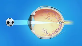 Nearsightedness (Myopia)