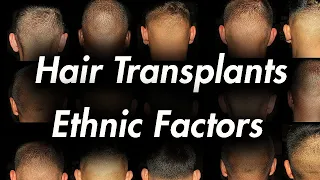 Hair Transplants and Ethnicity