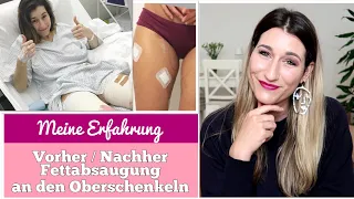 ICH HABE ES GETAN! Fettabsaugung an den Oberschenkeln | VORHER/NACHHER | Ablauf, Schmerzen, Kosten