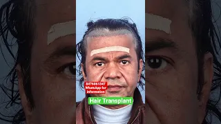 Rajpal Yadav 10 Month Hair Transplant Result| WhatsApp Guidance 8476061347