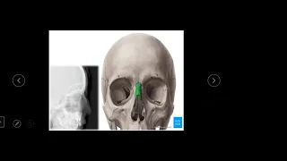 Skull bone Radiographic anatomy