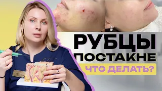 Как убрать шрамы и рубцы? Избавляемся с помощью субцизии рубцов