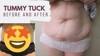 Tummy Tuck (Abdominoplasty) Before and After Photos- One year Post-Op