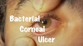 Medical Video Lecture Ophthalmology: Bacterial Corneal Ulcer