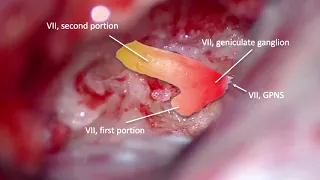 Middle Fossa Facial nerve decompression for Zoster