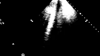 B lines - Interstitial Edema on Ultrasound