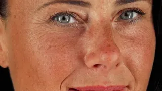 Can You Reverse Sun Damage? An Educational Video by Radium Medical Aesthetics