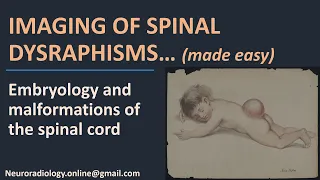 Pediatric Neuroradiology - Imaging of spinal dysraphisms... made easy