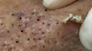Remove Blackheads and Hidden Acne At Loan Nguyen Spa #152