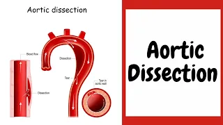 Aortic Dissection by Dr Kirun G, Consultant, Department of CVTS, Amrita Hospitals