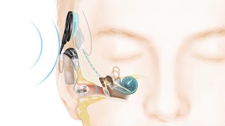 How Cochlear™ Hybrid™ Hearing Works