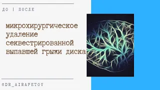 Микрохирургическое удаление секвестрированной выпавшей грыжи диска