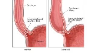 Achalasia