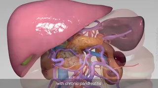 Total pancreatectomy with splenectomy, right hemicolectomy and reconstruction of portal vein