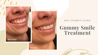 Gummy Smile Reduction Treatment by Dr. Nadir Qazi