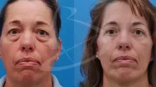 Eyelid Surgery: Before & After and Intro