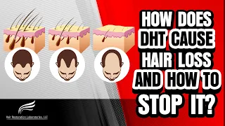 Hair Restoration Laboratories-Understanding How DHT Causes Hair Loss & How To Stop It