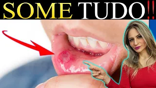 Homemade Recipe to End AFTAS is (RIGHT)!! Home remedies for thrush