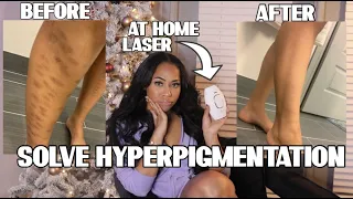 HOW TO FIX HYPERPIGMENTATION FAST: MY AT HOME LASER HAIR REMOVAL HORROR STORY.