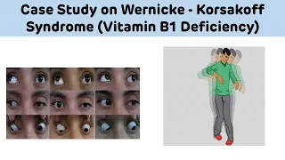 Case Study On Wernicke Korsakoff Syndrome (Vitamin B1 Deficiency) || Biochemistry Case Study