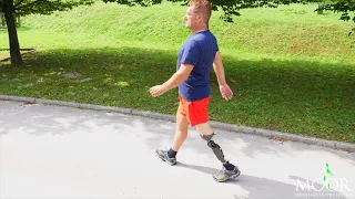 Amputee walking with microprocessor knee