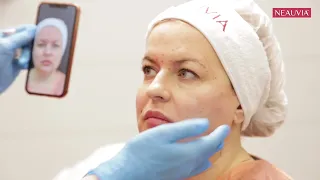 Авторский метод True Face, Neauvia Stimulate Man и ботулинотерапия в одной процедуре
