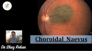 Choroidal Naevus: What is it? How is it Diagnosed? Treatment? What Else Could it be? I Rehan, 2021