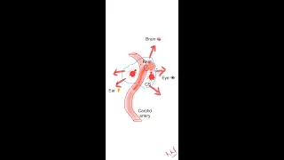 Carotid-cavernous fistula EMBOLISATION