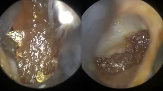 118 - Completely Blocked & Impacted Ear Wax Removal using WAXscope®️