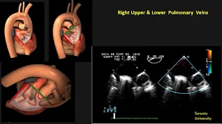 Tips & Mistakes: Pulmonary vein Pulse Doppler on TTE , TEE in Adult & Pediatric