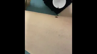 Tick Removal with "Ticked Off" Spoon