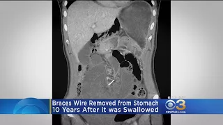 Braces Wire Removed From Woman's Stomach 10 Years After Swallowing It