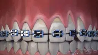 Gum Recession After Wearing Braces Can Now Be Treated Without Gum Grafting Surgery
