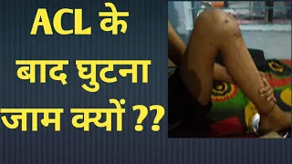 ACL या घुटने के ऑपरेशन के बाद जाम घुटने का इलाज़ / why stiff knee after ACL surgery