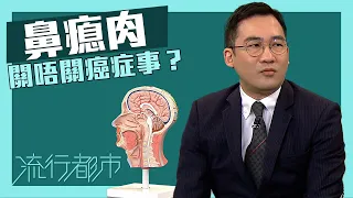 流行都市｜鼻瘜肉關唔關癌症事？｜鼻竇炎｜鼻瘜肉