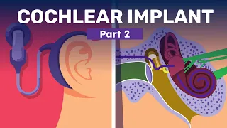 Are You Eligible for Cochlear Implants?