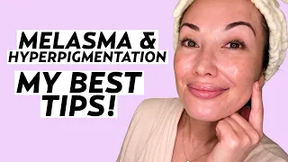 My Best Tips for Melasma & Hyperpigmentation-Prone Skin | Skincare with Susan Yara