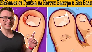 Как избавиться от грибка на ногтях быстро и безболезненно!