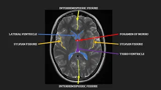 Introduction to MRI of the brain