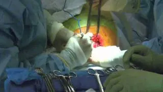 SC01367A - Alexis O C-Section Retractor.wmv