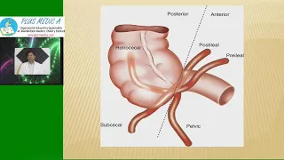 APENDICITIS AGUDA