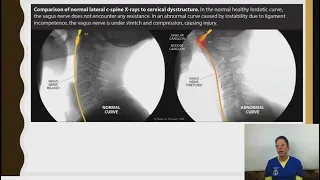 Vagus Nerve Function & Pathology Webinar - Part 1- Ross Hauser, MD