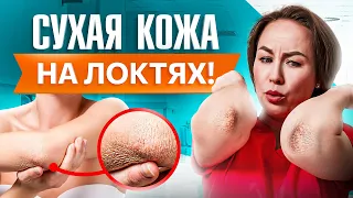 Сухая кожа на локтях! Почему крема не помогают? Причина внутри