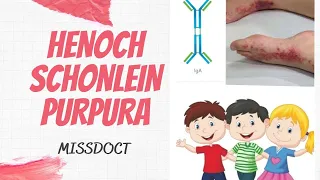 HENOCH SCHONLEIN PURPURA  (IgA Vasculitis)