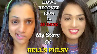 My Story Of Bell’s Pulsy,/Facial Paralysis/what to do & what not to do in Bell’s Pulsy चेहरे का लकवा